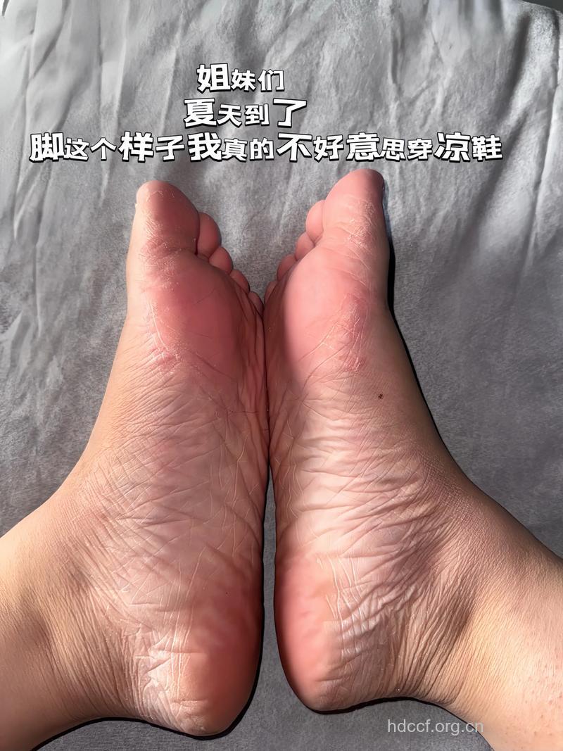 夏天光脚穿凉鞋不利于健康