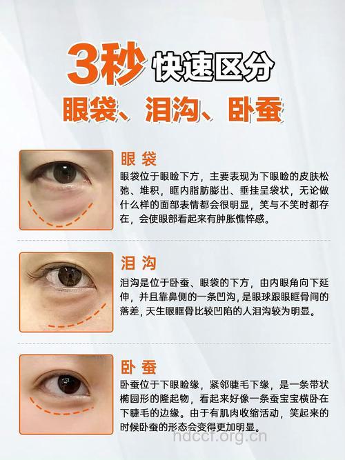 卧蚕和眼袋的区别是什么 如何去除眼袋