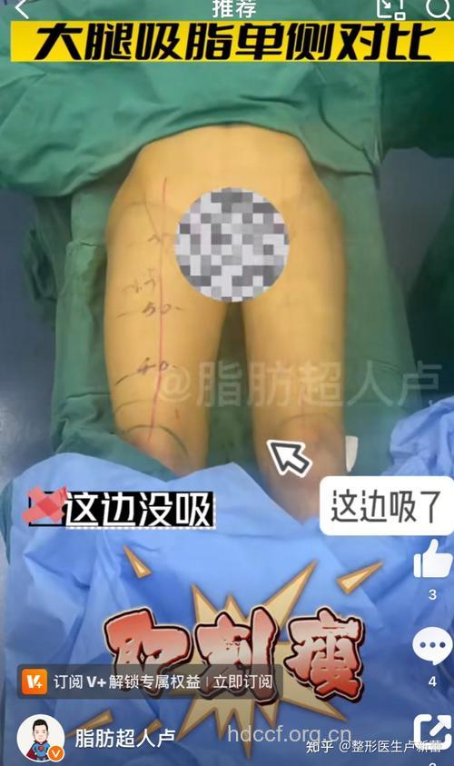 大腿抽脂会影响走动吗