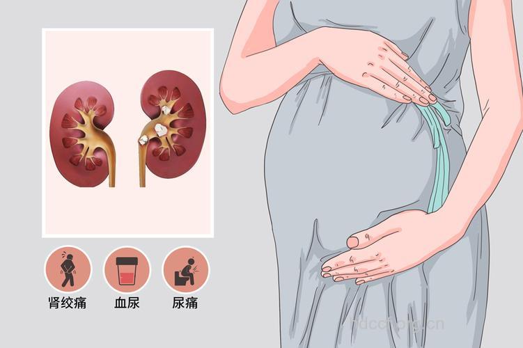 妊娠期女性也要对抗肾结石