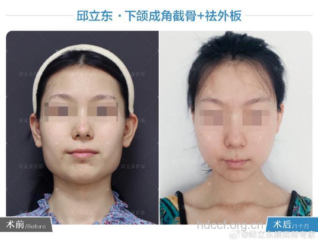 下颌角磨骨瘦脸术后4大护理重点应做好