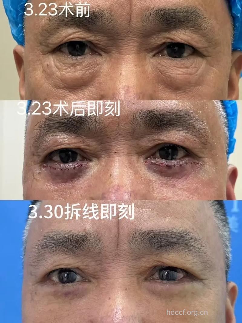 吸脂祛眼袋怎么做 术后不反弹效果好