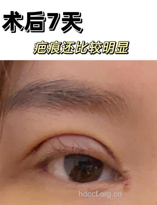 开眼角担心留疤 教你几招避免