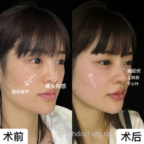 玻尿酸隆鼻后不能侧着睡 你知道吗