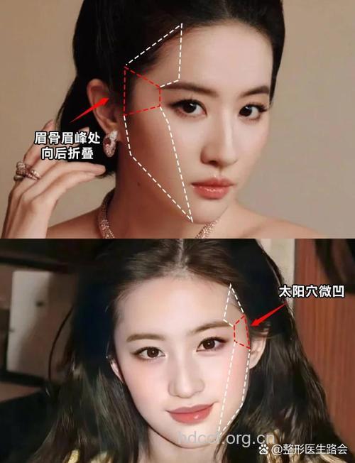 假体丰太阳穴 让你变身富贵相