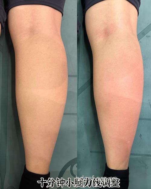 激光溶脂瘦大腿 脂肪过厚不宜做