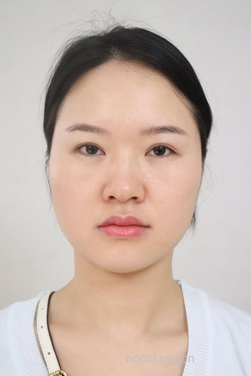 隆鼻手术后多久可以化妆 看术后恢复情况