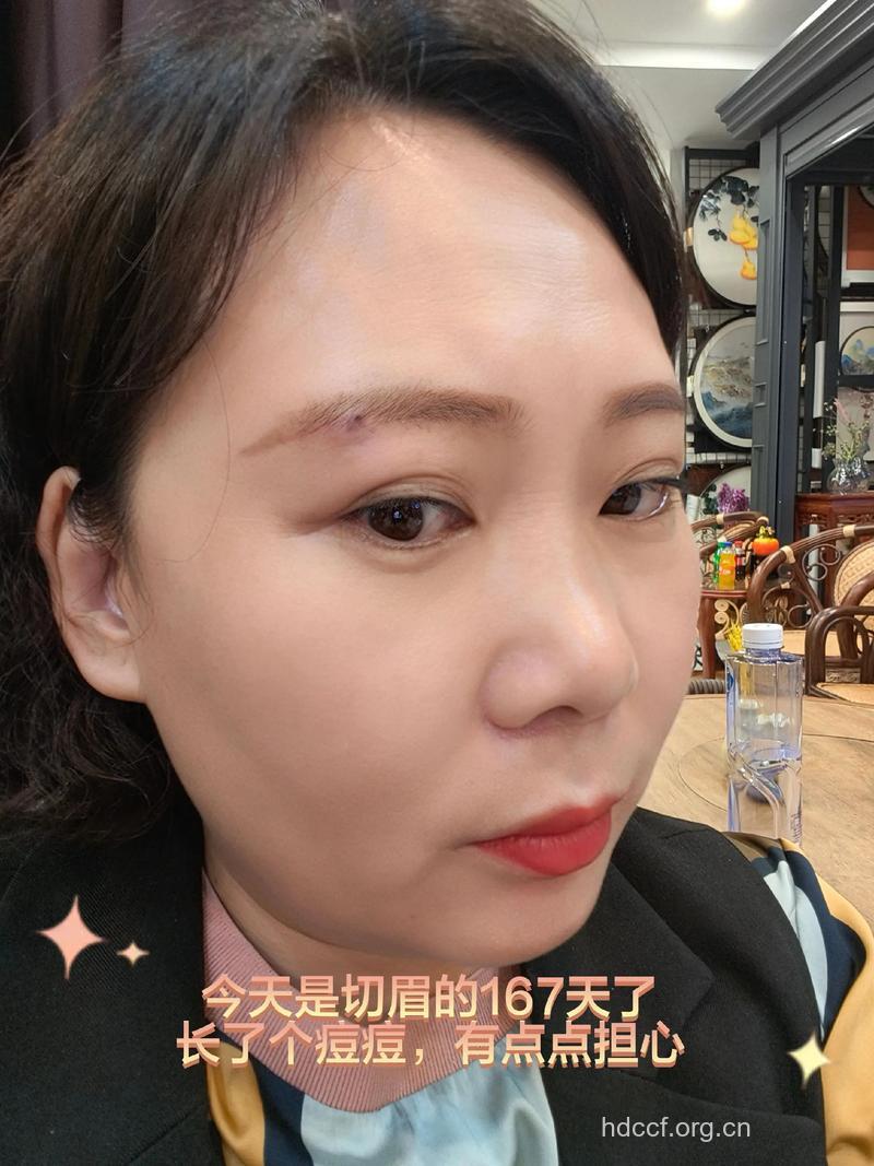 做切眉术会留下疤痕吗？