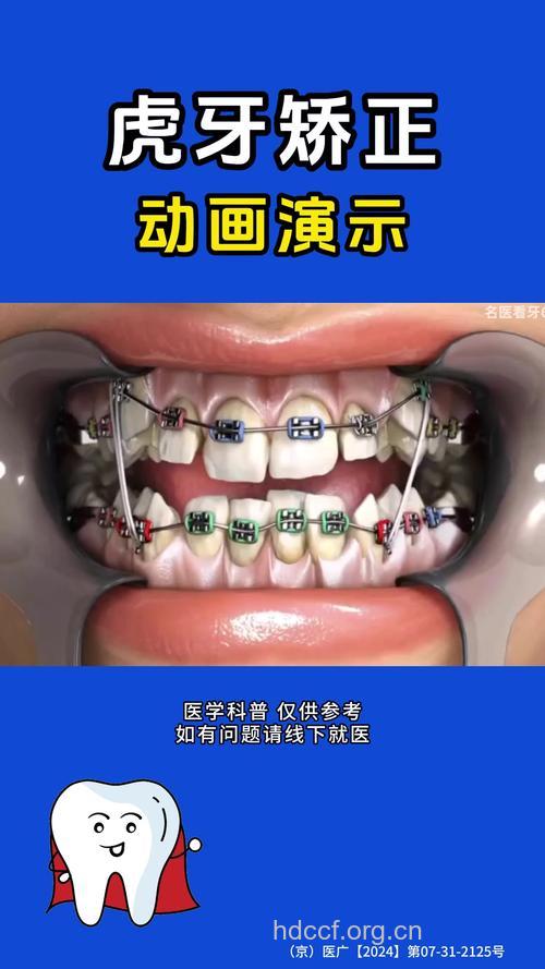 盘点矫正虎牙的五种方法