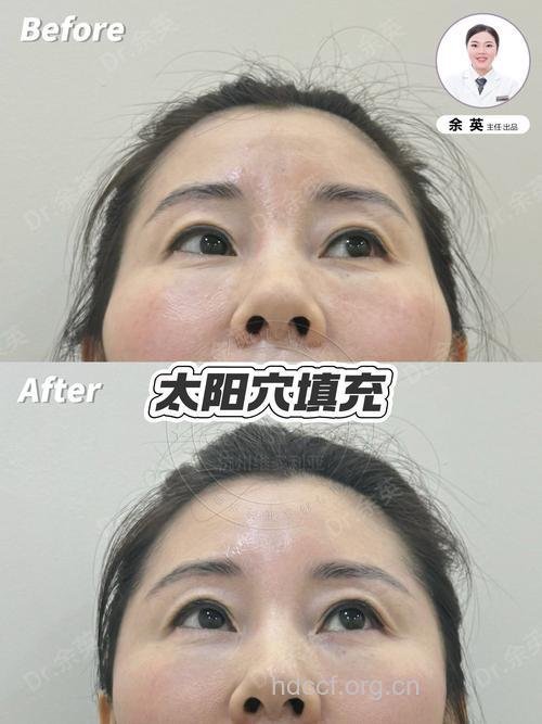 假体丰太阳穴效果如何 让脸型更加饱满