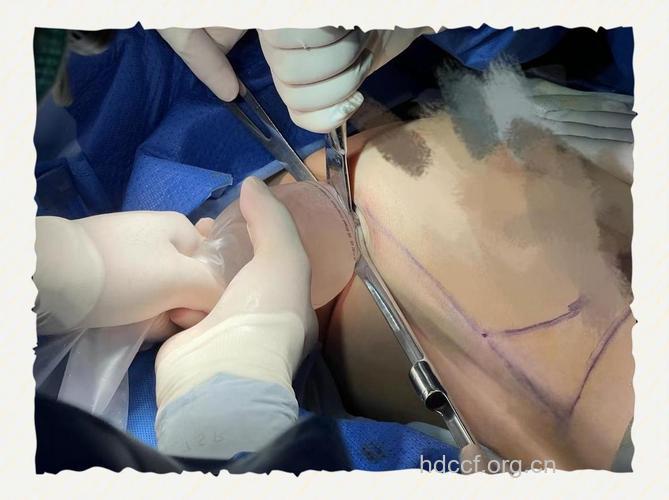 揭秘自体脂肪隆胸的两种手术方法