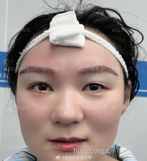 眉毛稀疏不好看 可以选择眉毛种植