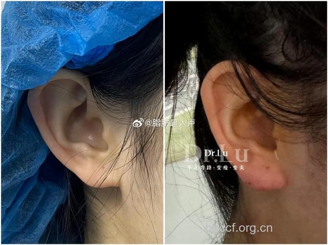 自体脂肪丰耳垂 增添你的福气