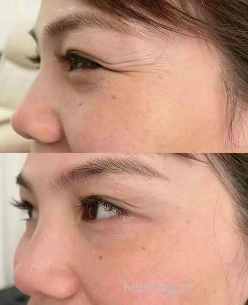 除皱针能消除哪些皱纹 脸部细纹各个击破