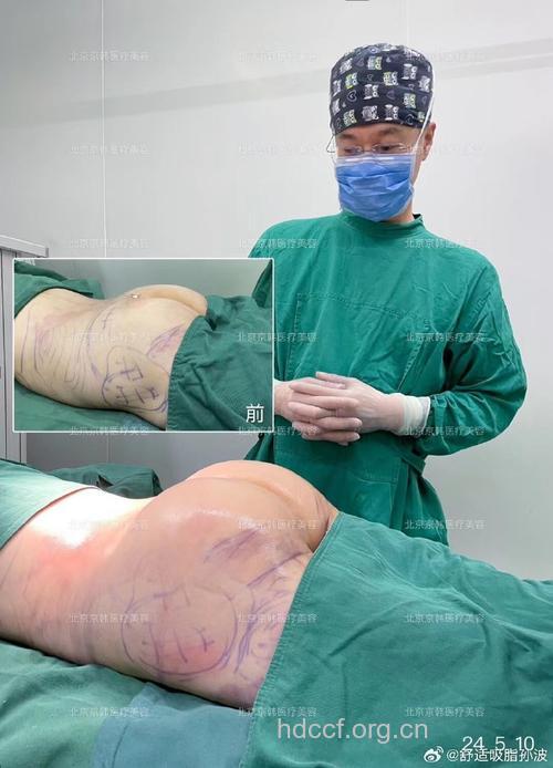 臀部吸脂手术安不安全呢?
