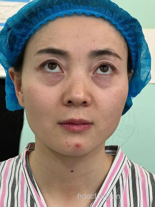 眼袋抽脂术效果如何 术前术后要留心
