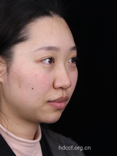 注射玻尿酸隆鼻后鼻子自然吗?