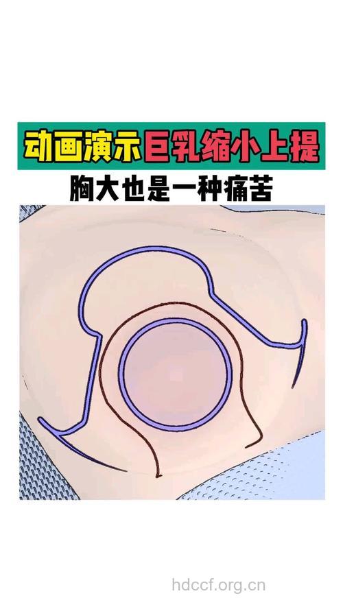 巨乳缩小安全性高不高呢？