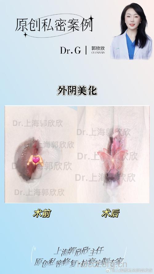 阴蒂肥大缩小术 让生活更和谐