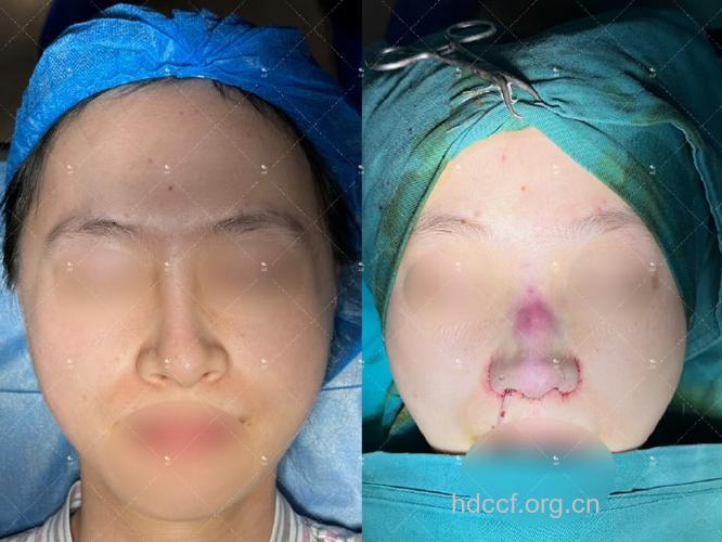 注意！硅胶隆鼻术后不可挤压鼻部