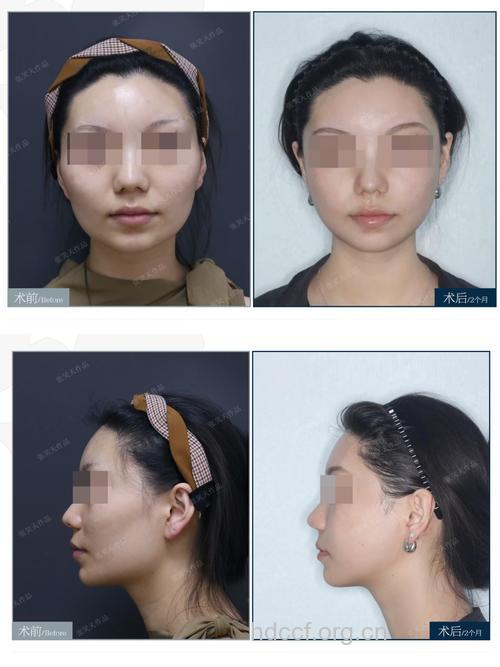 磨骨改脸型会伤及神经？并不是危言耸听