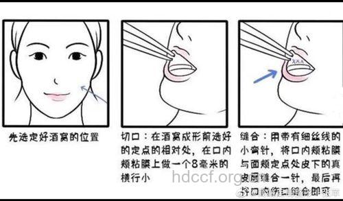 盘点酒窝形成术的手术方法