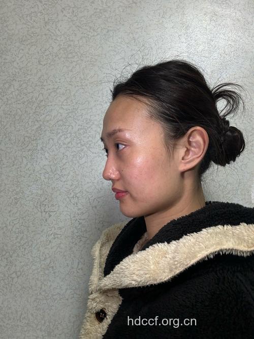 下颌角整形恢复快吗 术后护理注意这几点