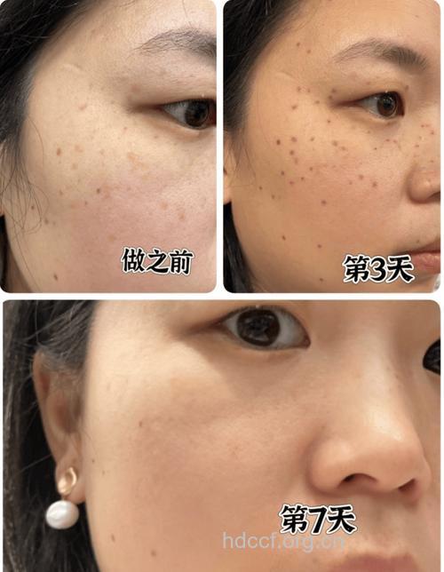 激光祛斑优势多 美白肌肤效果好