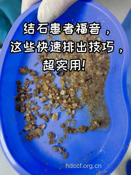 如何才能排出肾结石呢
