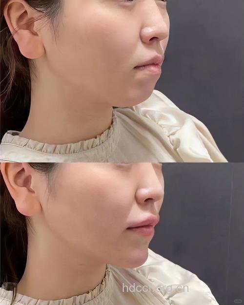 玻尿酸隆下巴安全吗 不动刀不留痕