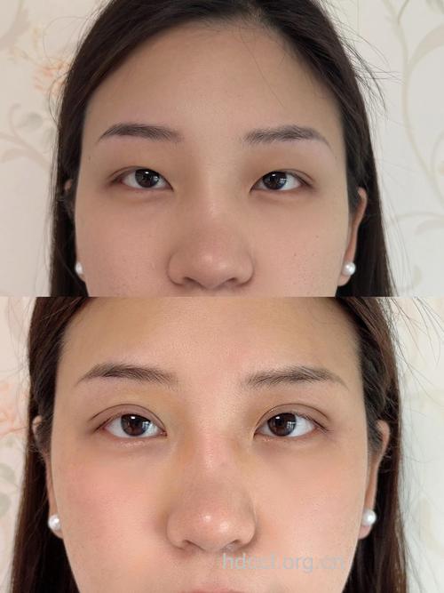 韩式三点重睑术 打造效果逼真的双眼皮