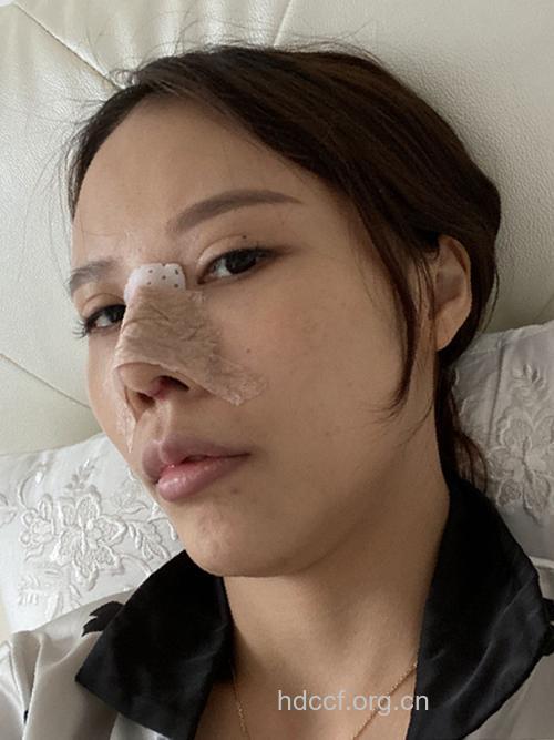 膨体隆鼻术后超自然 打造完美鼻型