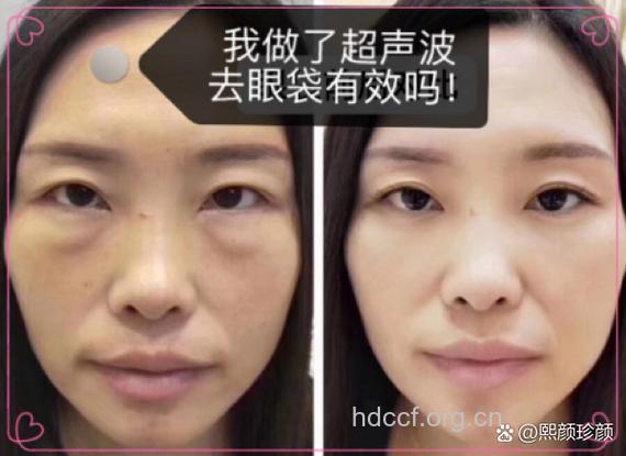 超声波祛眼袋效果好吗？
