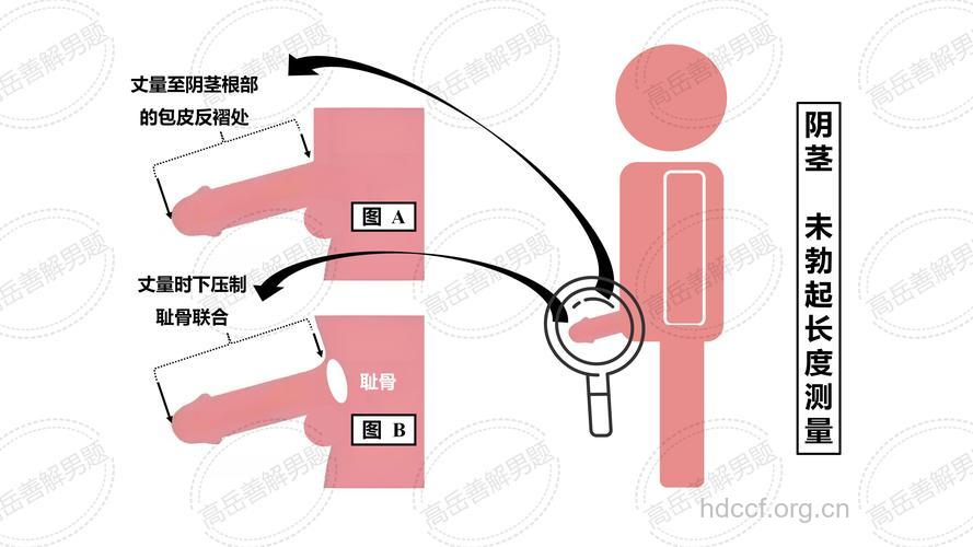 命根太短超自卑 推荐治疗阴茎延长的方法