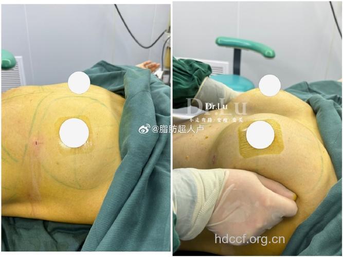 自体脂肪隆胸抽哪个部位效果好？