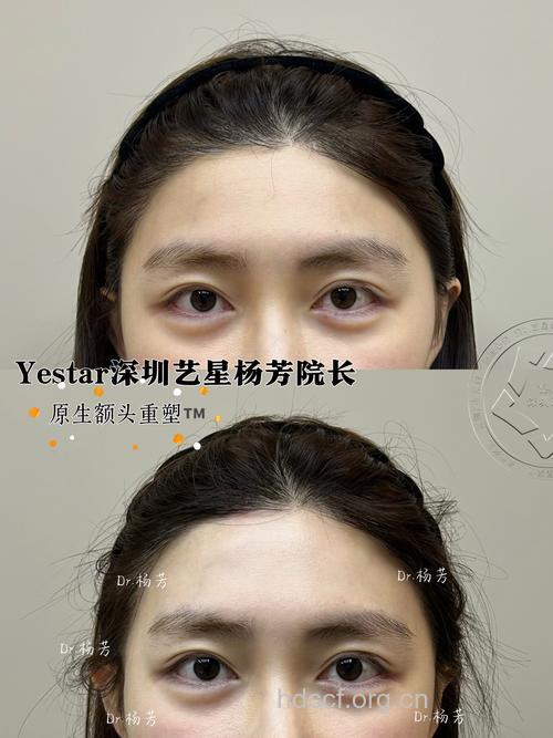 胶原蛋白丰额头有什么优势 更柔美自然