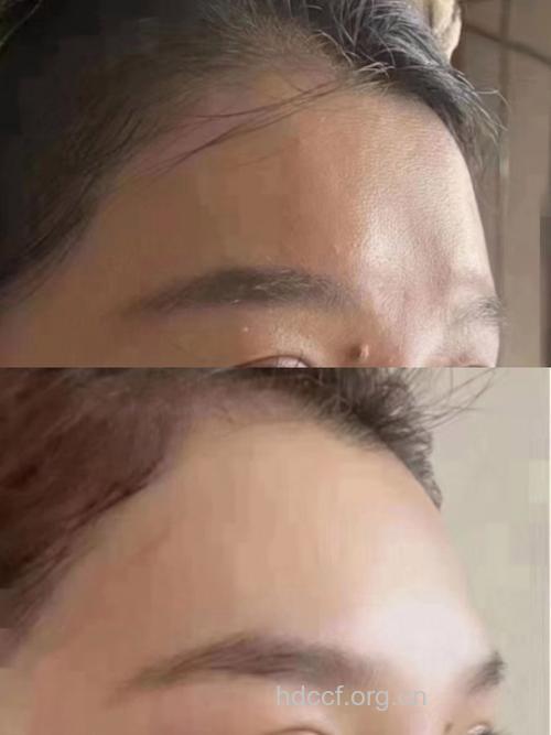 丰额头手术 帮你打造饱满天庭