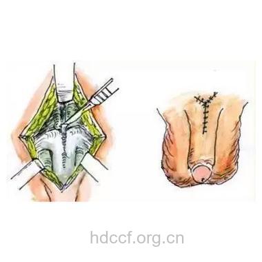 韩式阴茎延长手术 帮你做回真男人