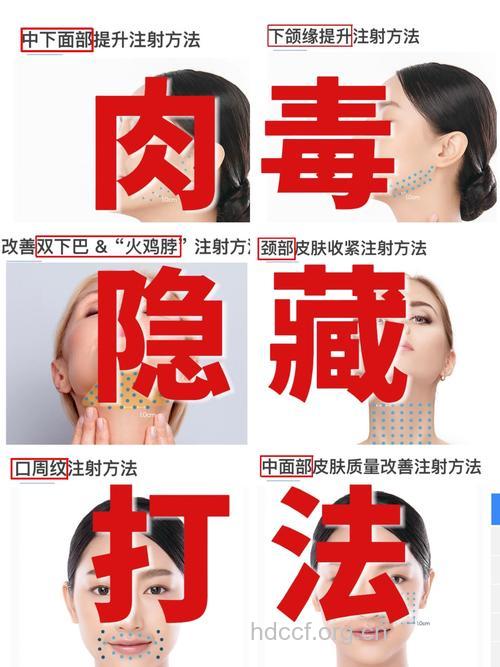 如何有效去除法令纹 试试注射肉毒素