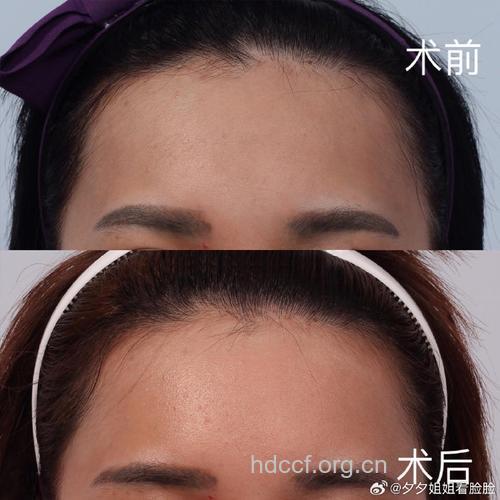 玻尿酸丰额头 见效快无痛苦