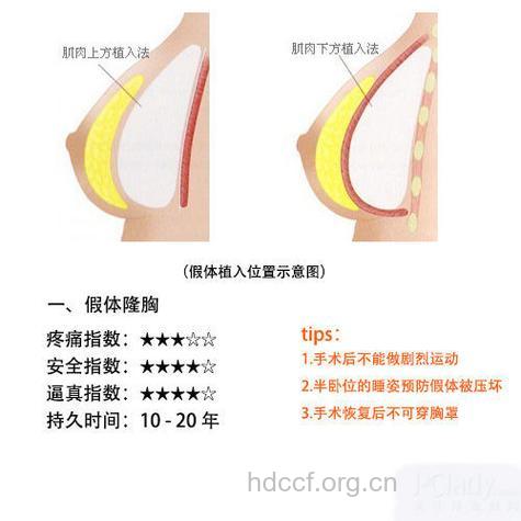 化身性感尤物 试试自体脂肪隆胸