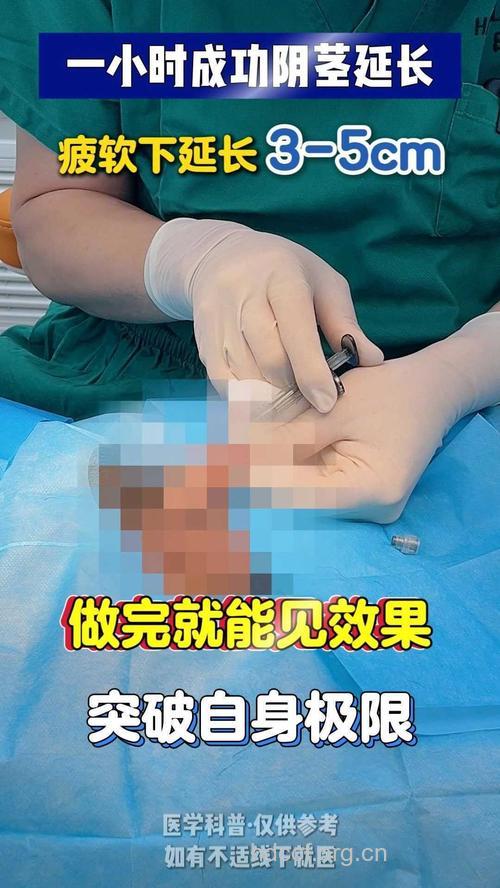 阴茎增大术效果好吗？恢复男性自信