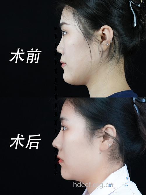 假体隆鼻效果如何 打造完美鼻型