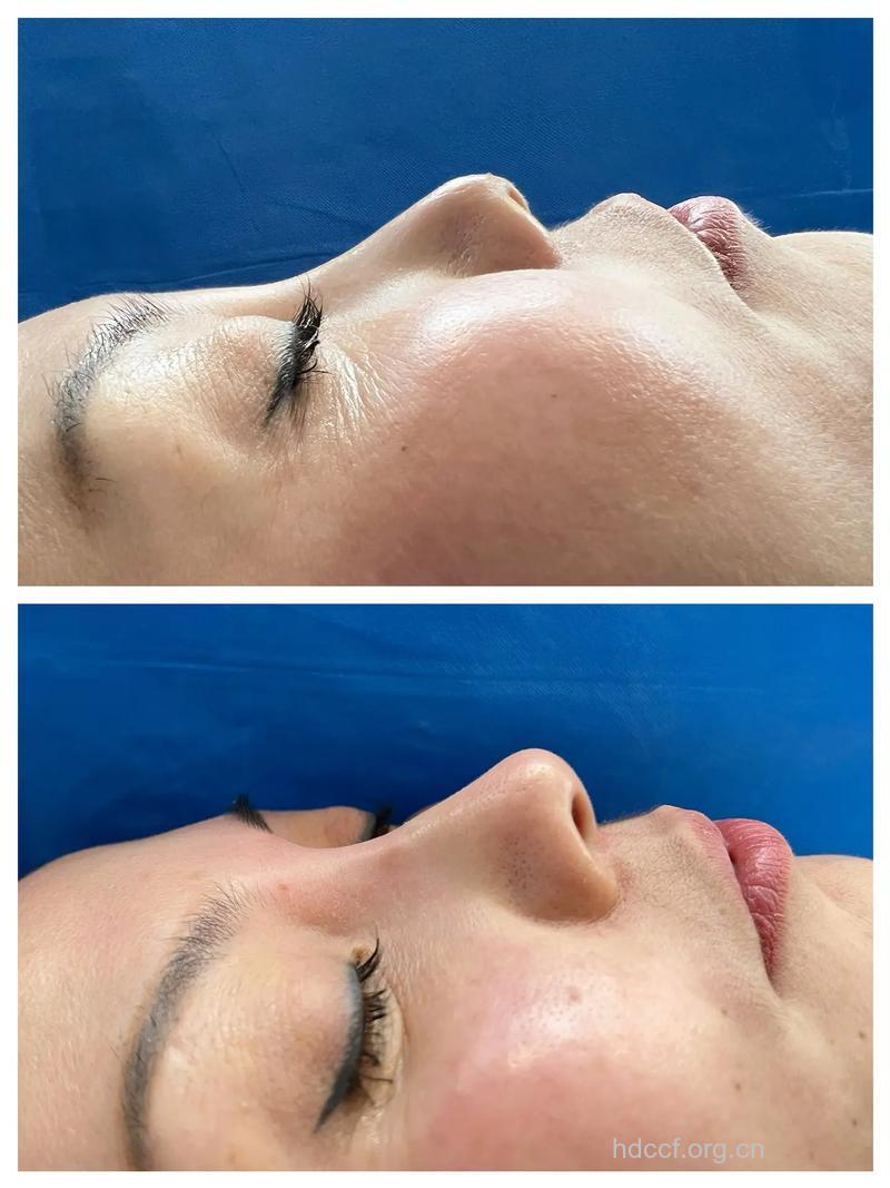 雕刻鼻整形 一气呵成宛如天生