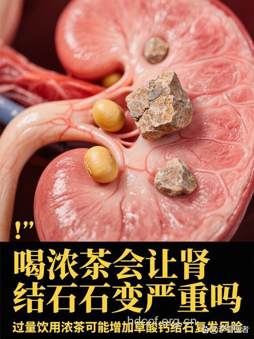 解读：茶+奶“溶解”肾结石