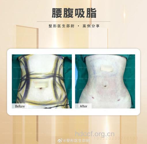 腰部吸脂帮你告别水桶腰 这些人最适合做