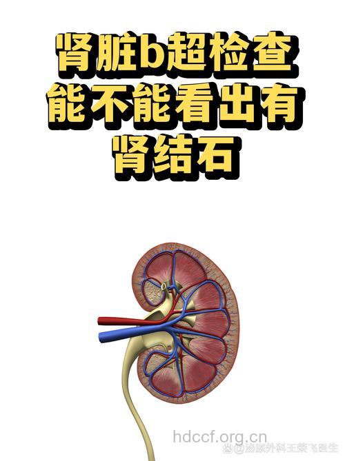 如何诊治肾结石?肾结石的4大影像检查方法