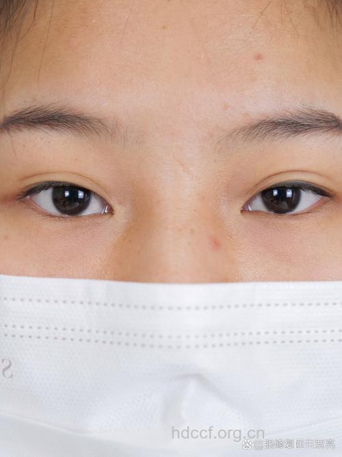 埋线双眼皮缝线会不会脱落