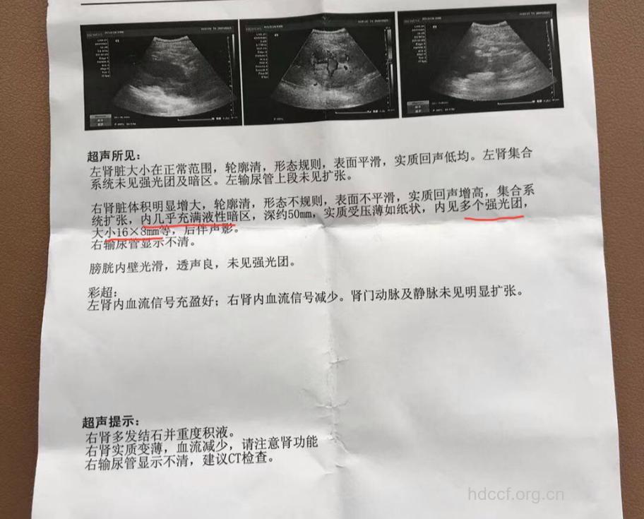 肾结石如何进行诊断