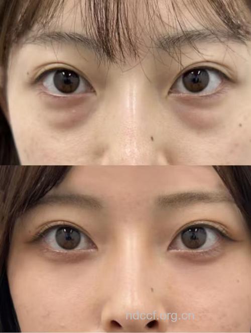 射频溶脂祛眼袋 有效改善松弛皮肤